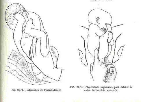 maniobras para parto podalico